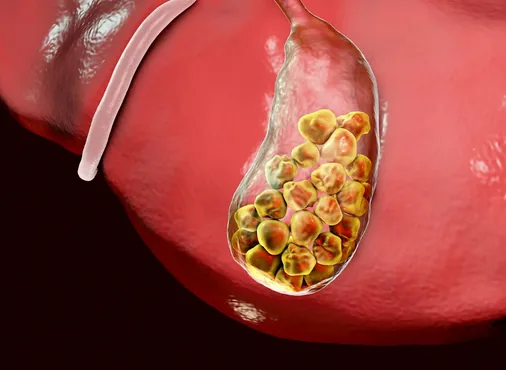 Gallstones (Cholelithiasis) and Acute Cholecystitis consultation at Niraaya Hospital